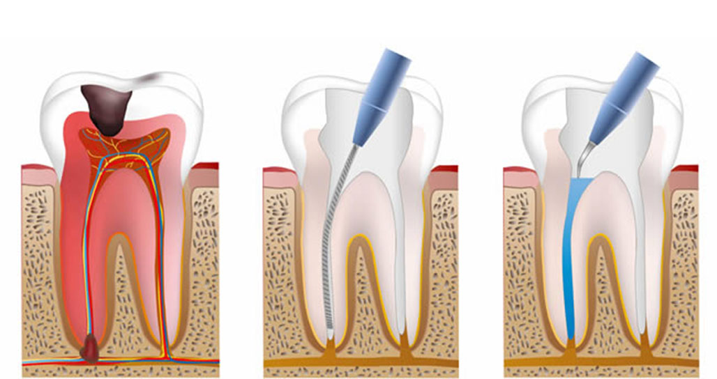 ROOT CANAL TREATMENT